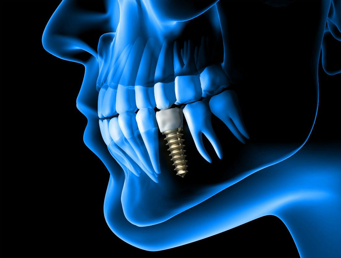 Dental Implants Pleasanton, CA